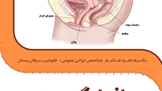 افتادگی رحم