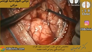 جراحی گلیوم ناحیه کورتکس حرکتی