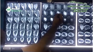 فیلم خارج سازی تومور بدخیم استخوان