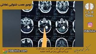 تومور عصب شنوایی تعادلی