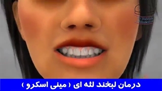 درمان لبخند لثه ای (مینی اسکرو) | دکتر احسان مهریزی