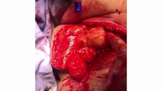 فیلم خارج سازی لیپوسارکوم لگن