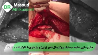 خارج سازی ضایعه سیستیک