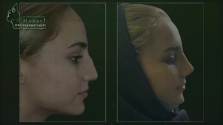 یک هفته بعد از جراحی بینی