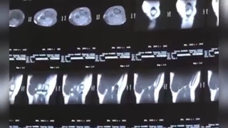 فیلم خارج سازی تومور استخوان زانو و ران