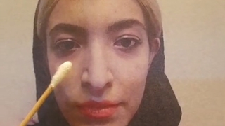 رینوپلاستی بینی استخوانی مدل نیمه فانتزی