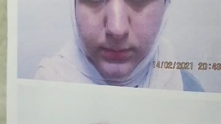 رینوپلاستی همزمان با لیفت اندوسکوپیک پیشانی