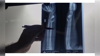 خارج سازی تومور ژانت سل