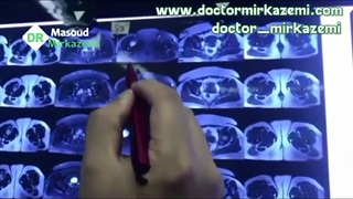 خارج سازی عروقی پروگزیمال فمور