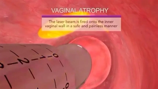 لیزر واژینال