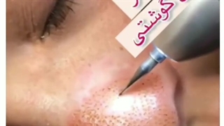 عوارض پلکسر بینی گوشتی