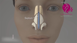 فیلم انیمیشنی جراحی زیبایی بینی
