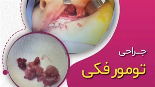 ...جراحى پولیپوز وسیع بینى و سینوزیت با روش آندوسکوپى