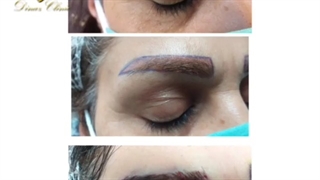 نمونه جراحی کاشت ابرو