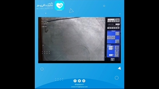 ترومبوساکشن