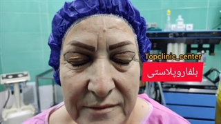 نتیجه عمل بلفاروپلاستی
