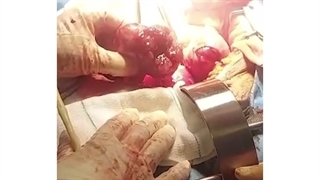 جراحی تومور روی تخمدان