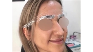 فیلم تزریق بوتاکس