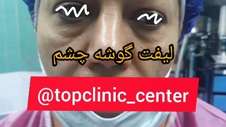 بلفاروپلاستی و لیفت گوشه چشم