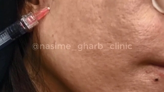 تزریق ژل پروفایلو صورت