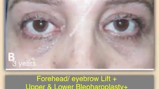 لیفت پیشانی و شقیقه به همراه بلفاروپلاستی و جراحی افتادگی پلک | دکتر کشکولی