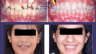 گالری درمان های ارتودنسی توسط دکتر جمیلیان / متخصص ارتودنسی