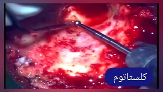 کلستاتوم