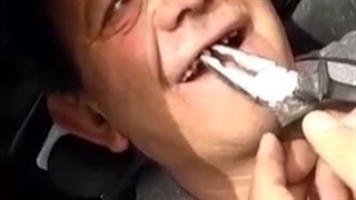 کشیدن دندون بدون دردو خون ریزی