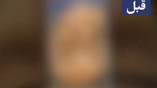 جراحی بینی دکتر علی طاهری نیا آر اف فرکشنال