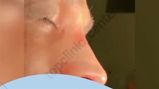 جراحی بینی به روش بسته
