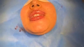 جراحی لب | دکتر شبنم شادابی