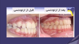 قبل و بعد درمان ارتودنسی توسط دکتر جمیلیان / متخصص ارتودنسی