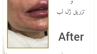 اصلاح خط خنده