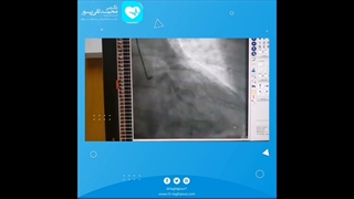 اهمیت قرص پلاویکس