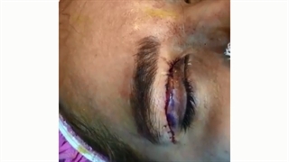 جراحی پلک بالا و لیفت گوشه چشم توسط دکتر ماریا مرادی