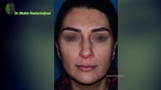 جراحی بینی برای اصلاح قوز و غیرقرینگی پره ها | دکتر باستانی | جراح بینی