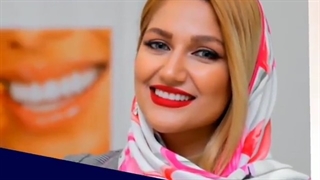 نتیجه بعد از ونیر کامپوزیت فک بالا در دندانپزشکی پارسه