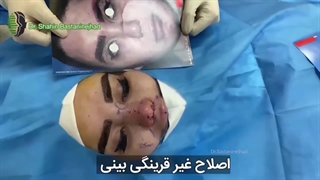 جراحی ترمیمی دشوار با سابقه 3 بار جراحی ناموفق | دکتر باستانی نژاد
