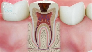 پر کردن و اصلاح ریشه دندان