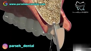 انیمیشن نحوه انجام ایمپلنت دندان