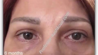 بلفاروپلاستی پلک بالا و فیکس غده اشکی | پروفسور کشکولی | جراح پلک تهران