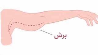 براکیوپلاستی یا جراحی لیفت بازو چگونه است؟