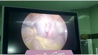 لاپاراسکوپی فیبروم رحم