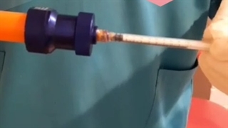 دکتر علیزاده بهترین دکتر برای تزریق چربی در تهران لیزر صورت