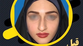 عمل بینی گوشتی با فرم نیمه فانتزی