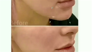 تزریق فیلر چانه و خط خنده