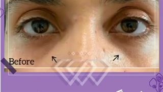 فیلم تزریق 1 سی سی فیلر برای رفع گودی زیر چشم