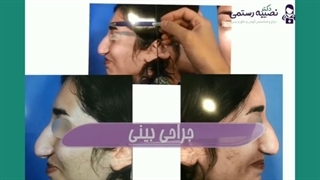 جراحی بینی توسط دکتر نصیبه رستمی