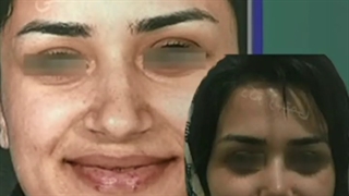 نمونه جراحی بینی گوشتی با انحراف و افتادگی زیاد