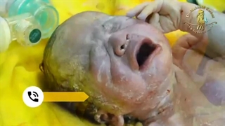 زایمان سزارین